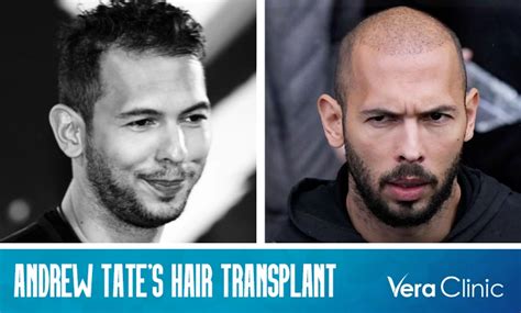 Andrew Tate: Hair Transplant Rumours, Bio, Fame,。